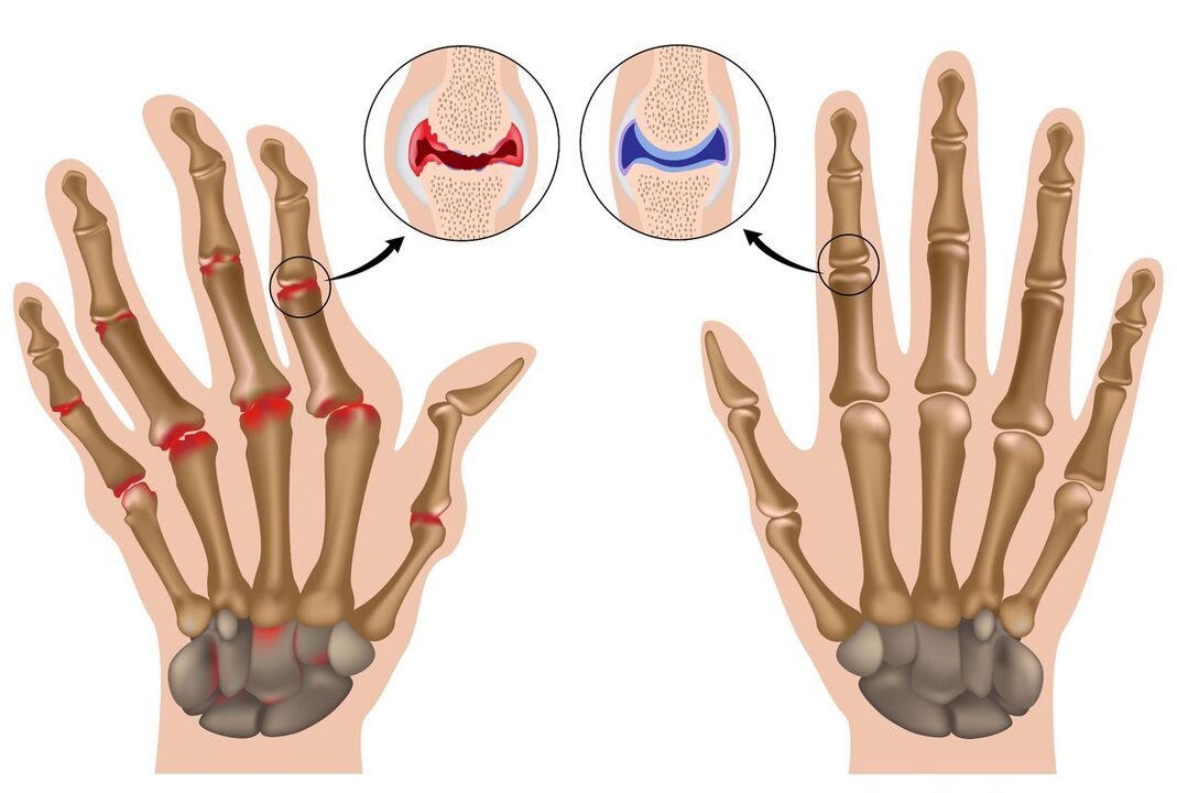 Articulaciones de la mano sanas y afectadas por poliartritis