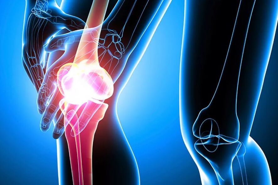 Osteoartritis de la rodilla
