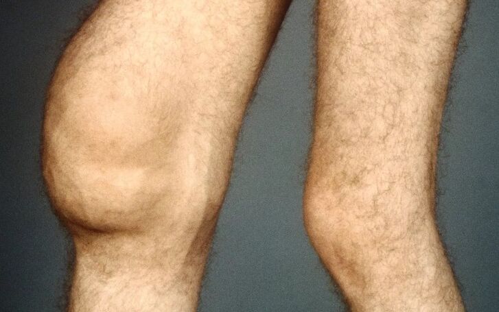 Post osteoartritis -traumático de la articulación de la rodilla