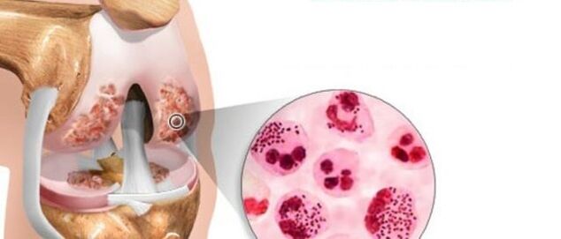lo que conduce al desarrollo de la osteoartritis