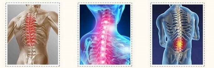 Lesiones de la columna de la osteocondrosis
