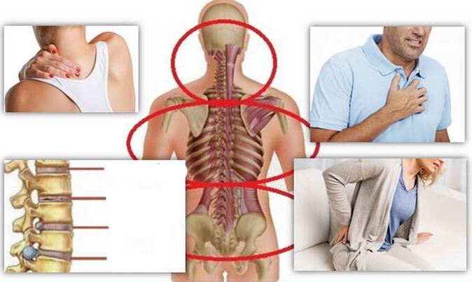 Lugares de enfermedad para la osteocondosis