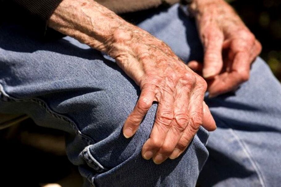 La osteoartritis es una enfermedad relacionada con la edad que afecta a las personas mayores.