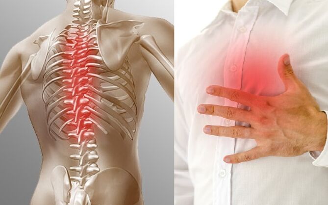 La osteocondrosis torácica se manifiesta por dolor y sensación de opresión en el pecho.